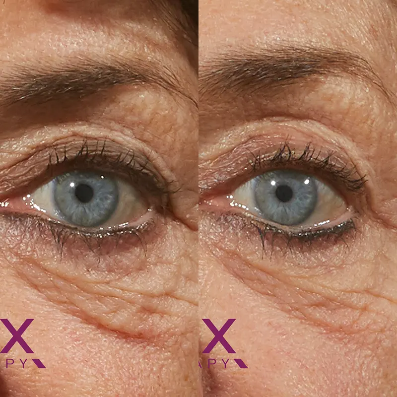 PRX Peeling μέσα αληθινές εικόνες Πριν και Μετά