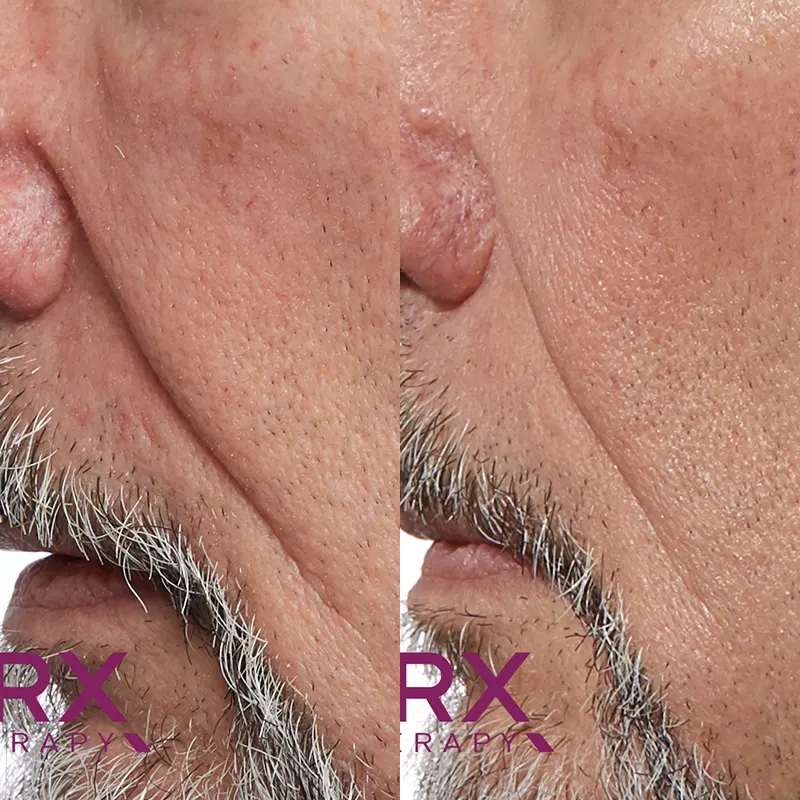 PRX Peeling μέσα αληθινές εικόνες Πριν και Μετά