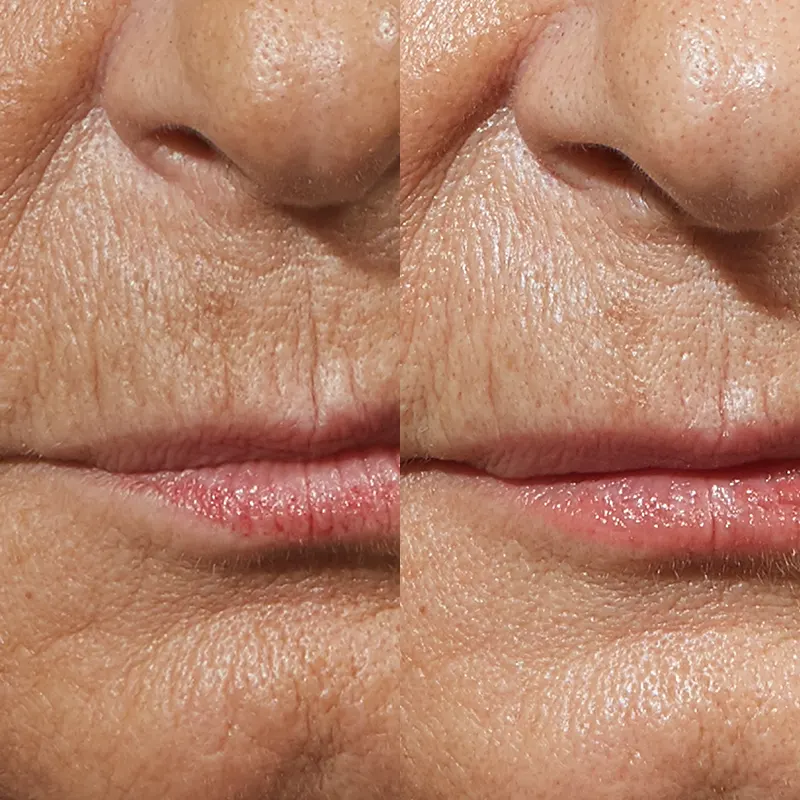 PRX Peeling μέσα αληθινές εικόνες Πριν και Μετά