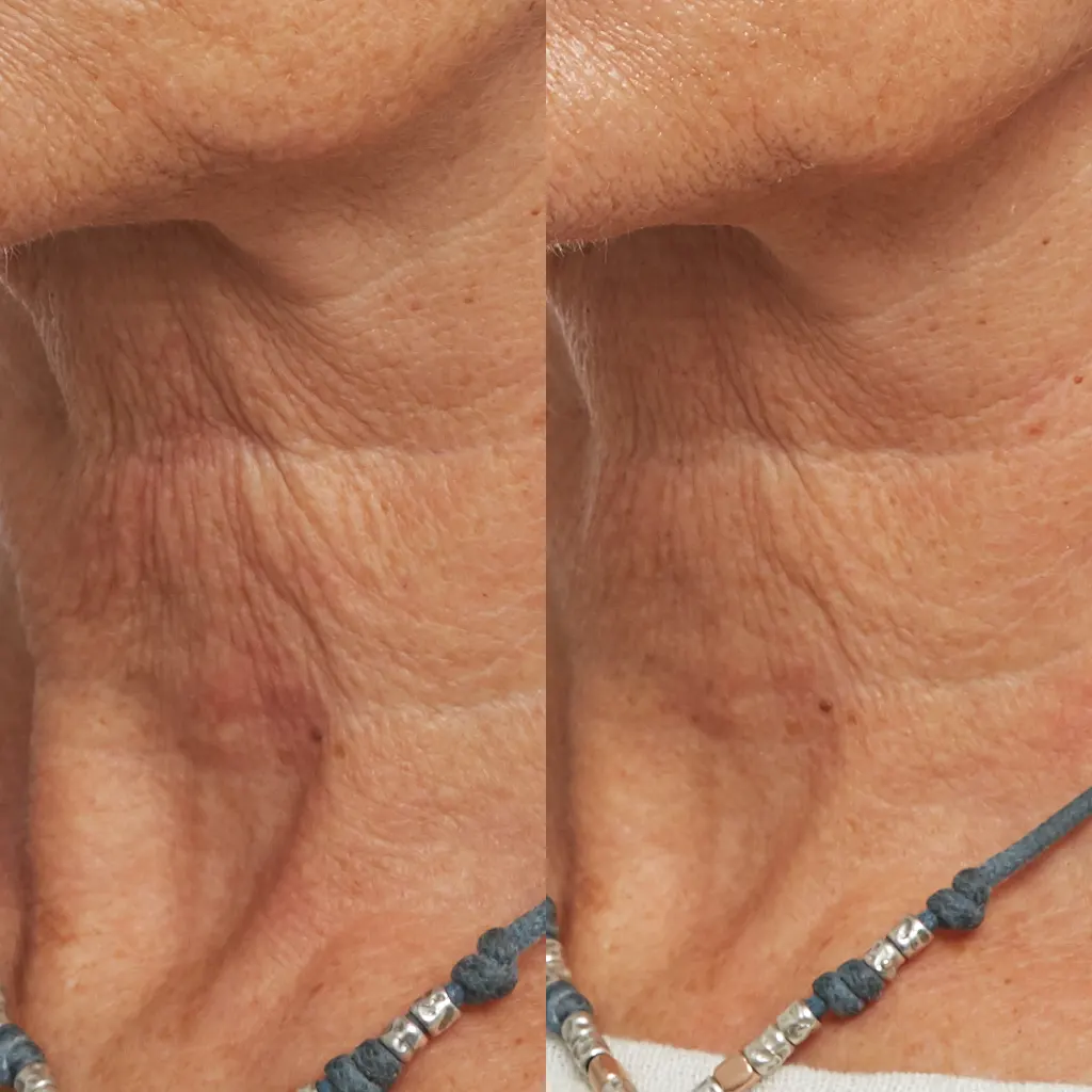 PRX Peeling μέσα αληθινές εικόνες Πριν και Μετά