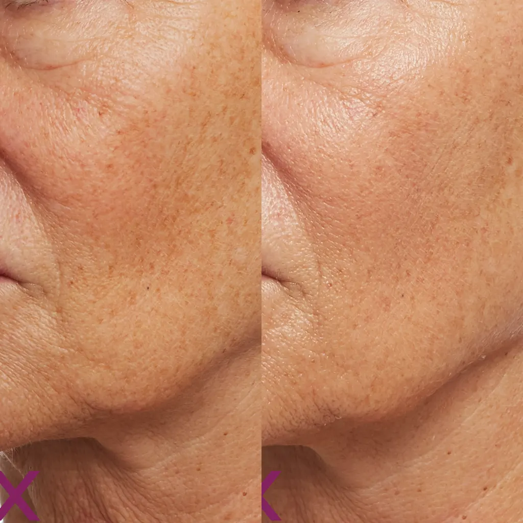 PRX Peeling μέσα αληθινές εικόνες Πριν και Μετά