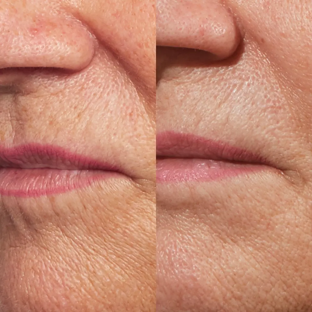 PRX Peeling μέσα αληθινές εικόνες Πριν και Μετά