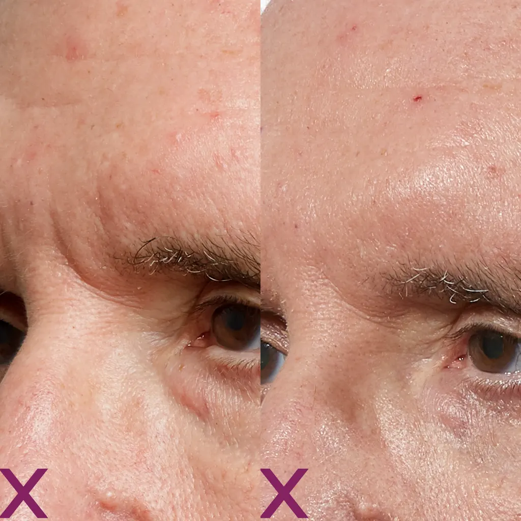 PRX Peeling μέσα αληθινές εικόνες Πριν και Μετά
