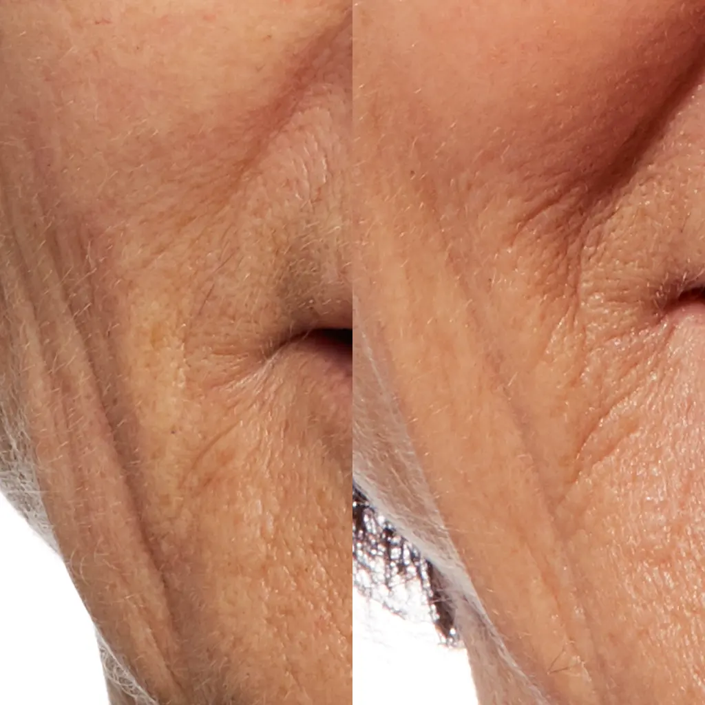 PRX Peeling μέσα αληθινές εικόνες Πριν και Μετά