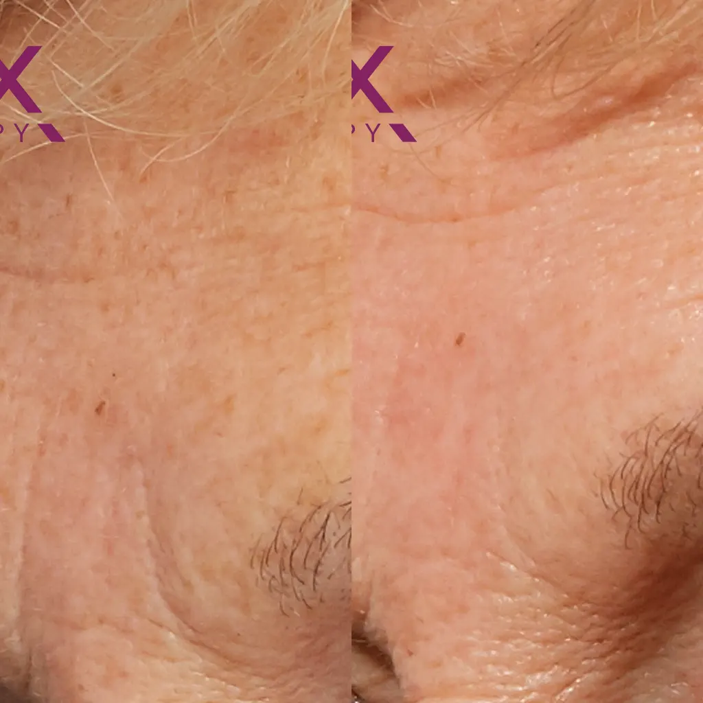 PRX Peeling μέσα αληθινές εικόνες Πριν και Μετά