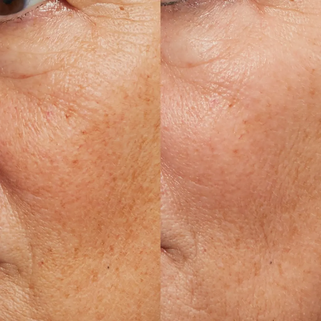 PRX Peeling μέσα αληθινές εικόνες Πριν και Μετά