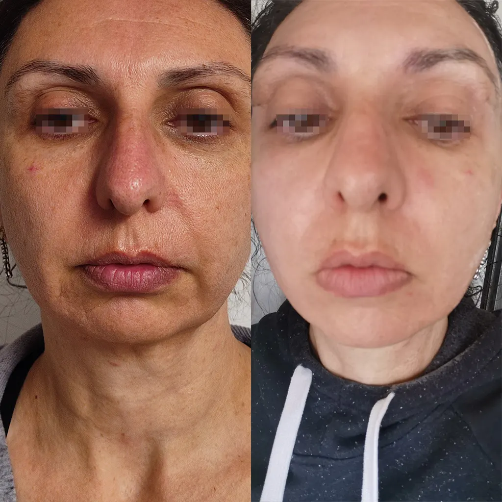 Χημικό Peeling μέσα αληθινές εικόνες Πριν και Μετά
