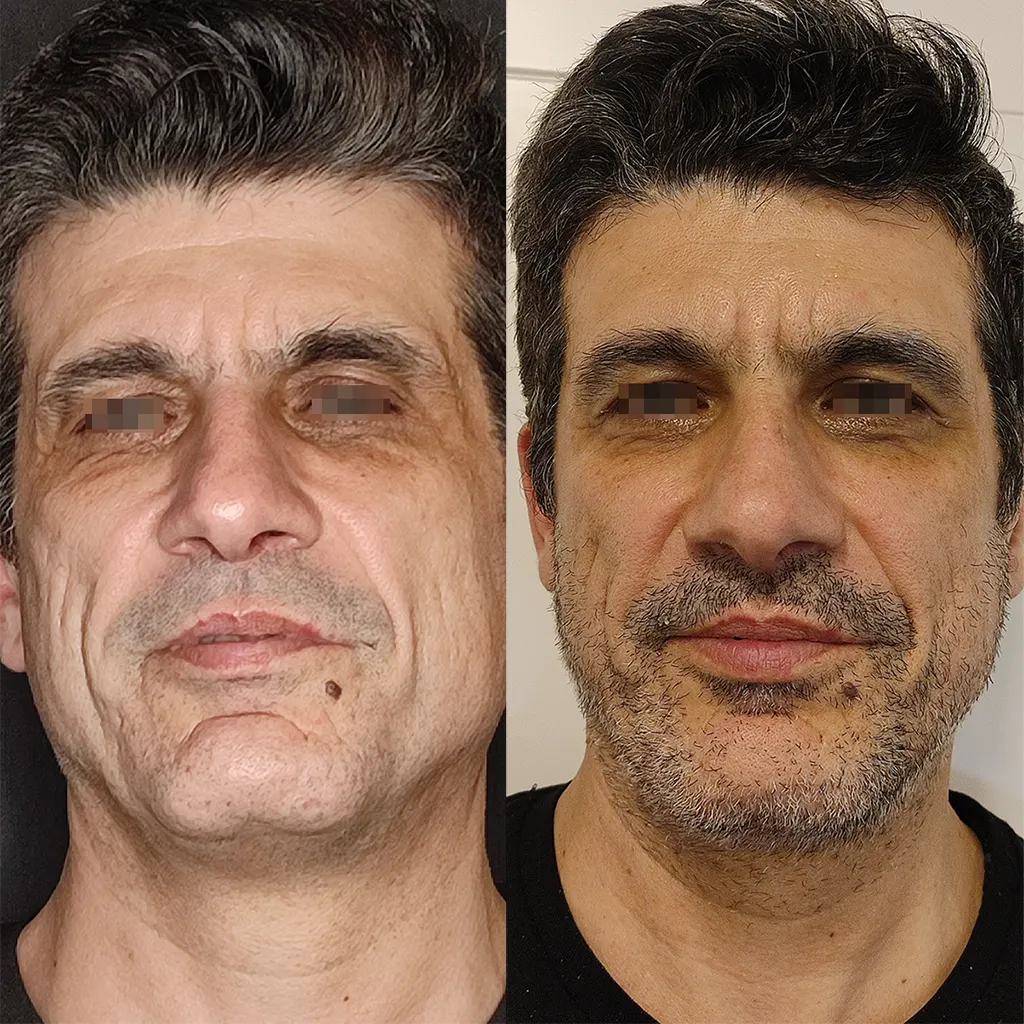 Χημικό Peeling μέσα αληθινές εικόνες Πριν και Μετά