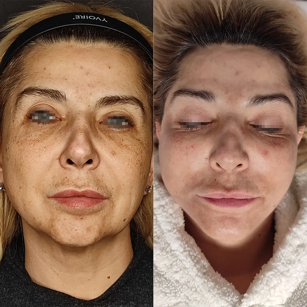 Χημικό Peeling μέσα αληθινές εικόνες Πριν και Μετά