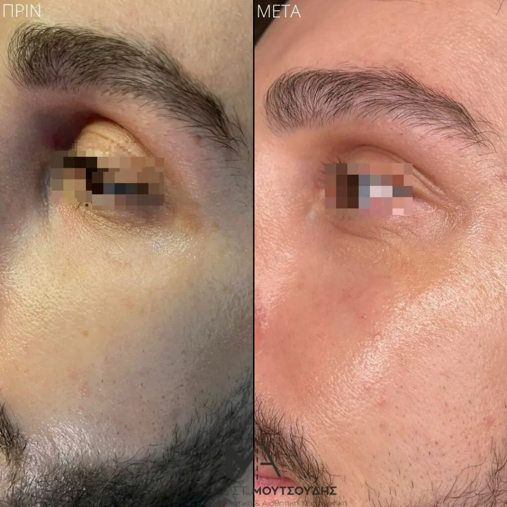 Υαλουρονικό Οξύ μέσα από αληθινές φωτογραφίες Πριν και Μετά