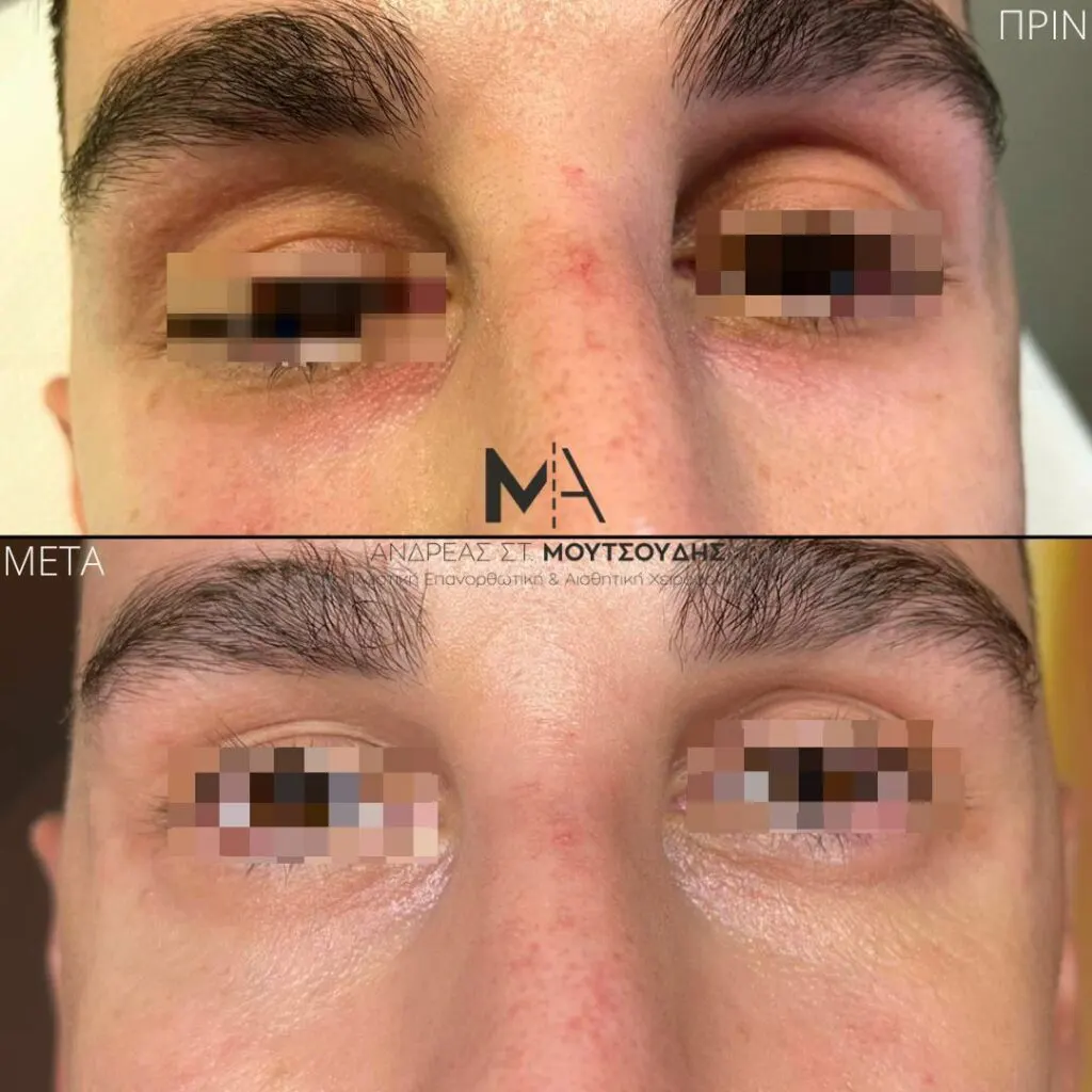 Υαλουρονικό Οξύ μέσα από αληθινές φωτογραφίες Πριν και Μετά