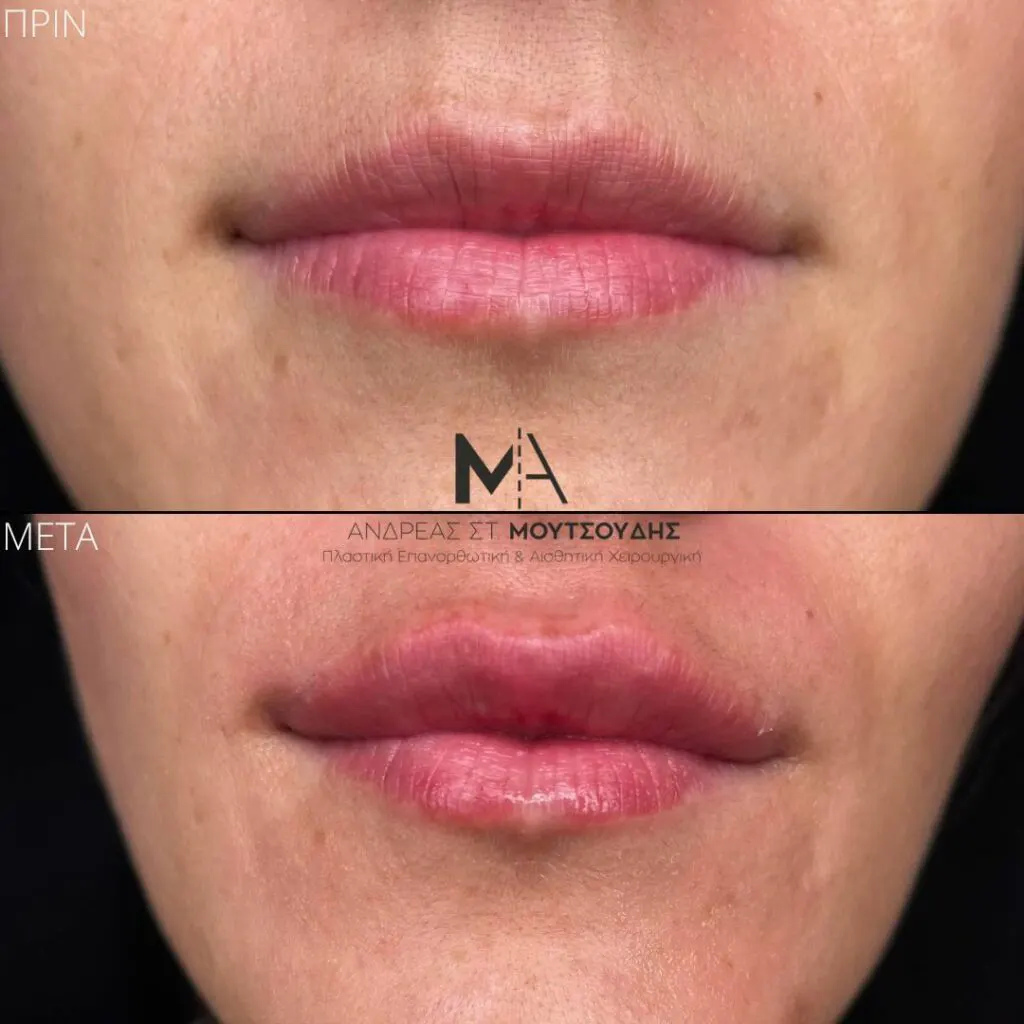 Υαλουρονικό Οξύ μέσα από αληθινές φωτογραφίες Πριν και Μετά