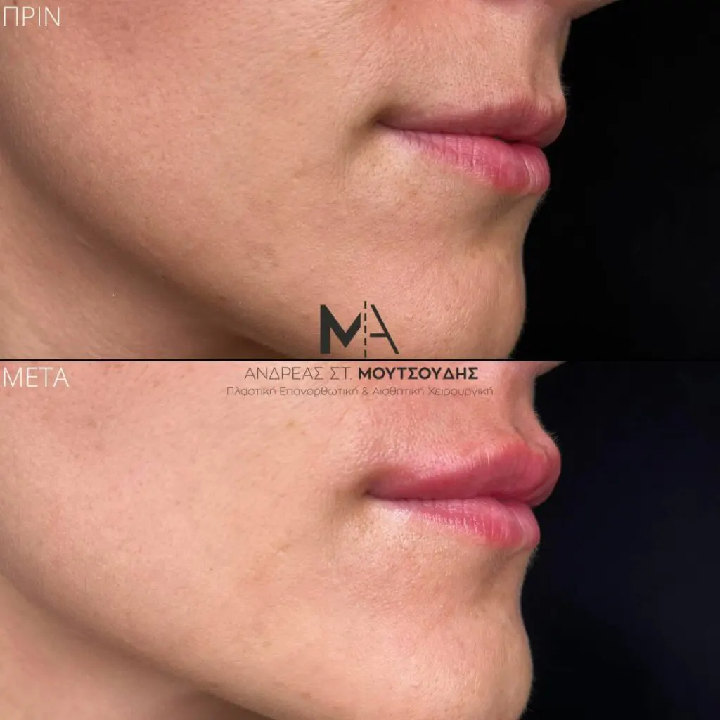 Υαλουρονικό Οξύ μέσα από αληθινές φωτογραφίες Πριν και Μετά