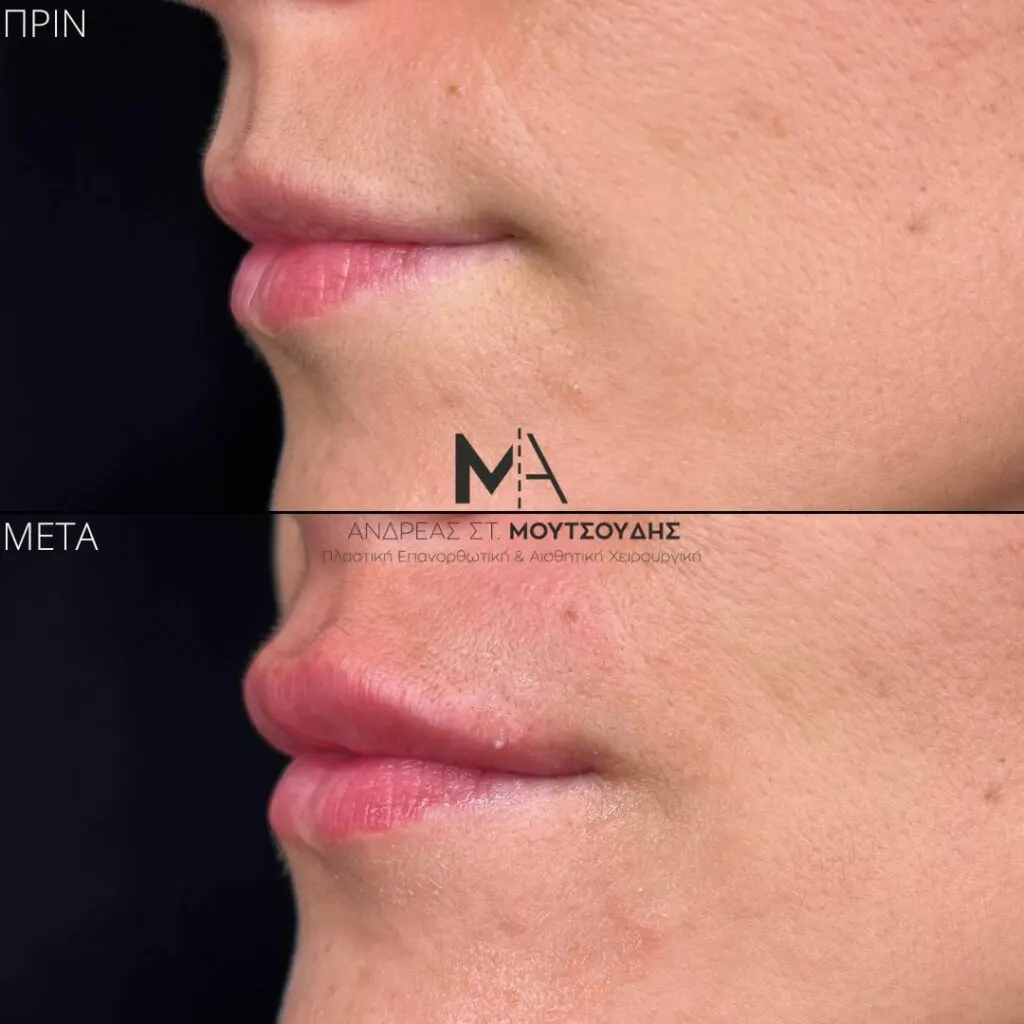 Υαλουρονικό Οξύ μέσα από αληθινές φωτογραφίες Πριν και Μετά