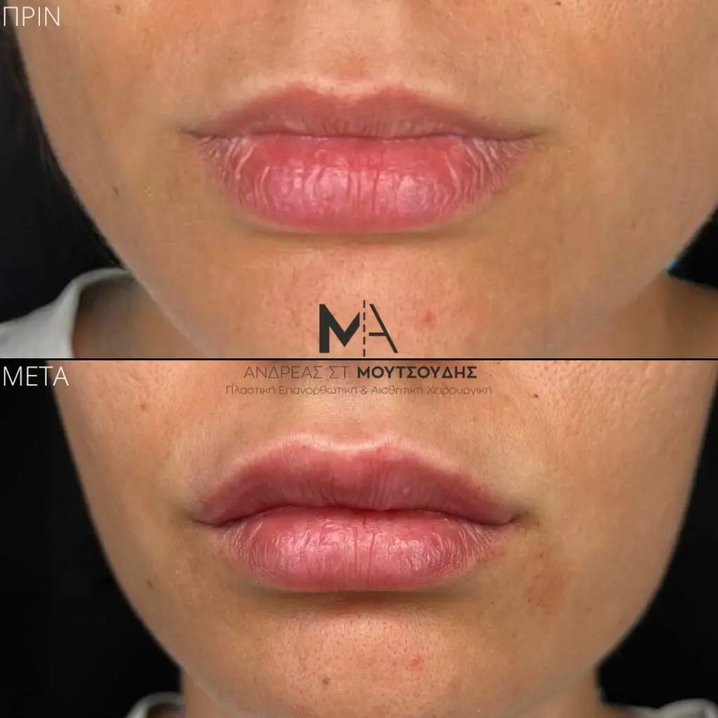 Υαλουρονικό Οξύ μέσα από αληθινές φωτογραφίες Πριν και Μετά