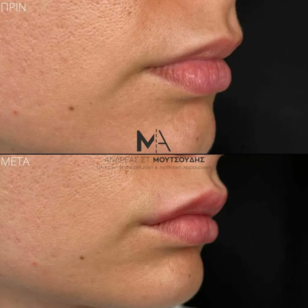 Υαλουρονικό Οξύ μέσα από αληθινές φωτογραφίες Πριν και Μετά