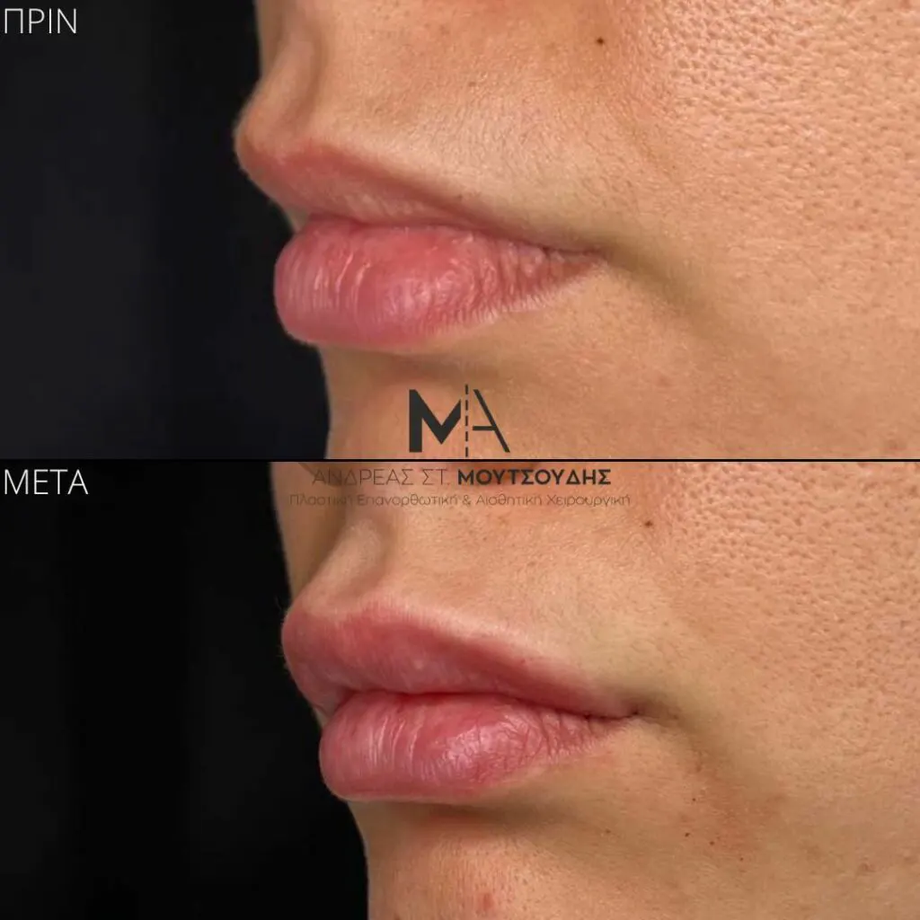 Υαλουρονικό Οξύ μέσα από αληθινές φωτογραφίες Πριν και Μετά