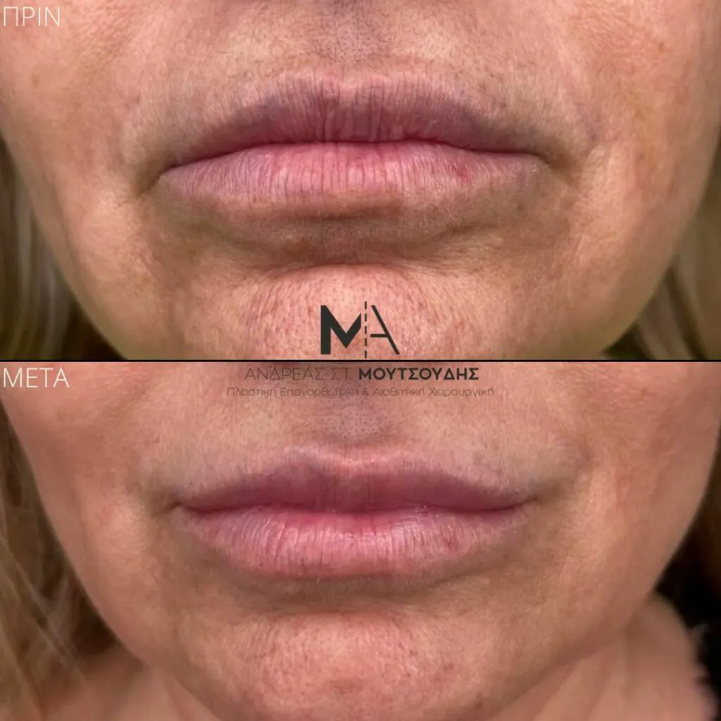 Υαλουρονικό Οξύ μέσα από αληθινές φωτογραφίες Πριν και Μετά