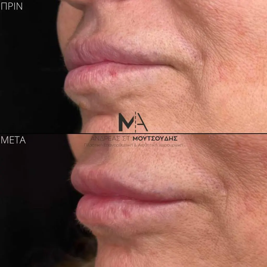 Υαλουρονικό Οξύ μέσα από αληθινές φωτογραφίες Πριν και Μετά