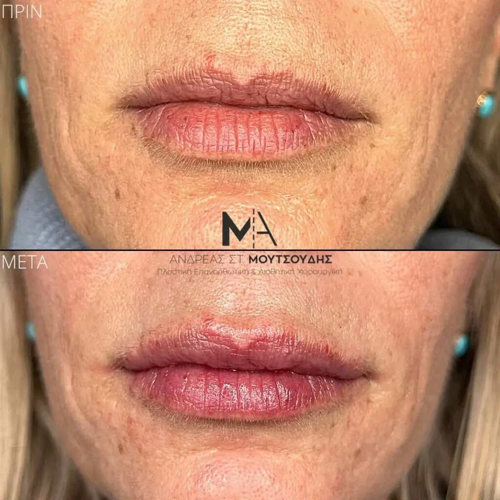 Υαλουρονικό Οξύ μέσα από αληθινές φωτογραφίες Πριν και Μετά