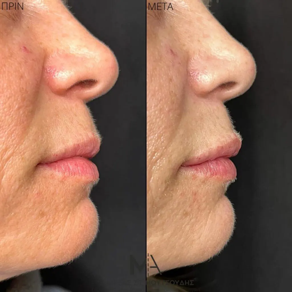 Υαλουρονικό Οξύ μέσα από αληθινές φωτογραφίες Πριν και Μετά