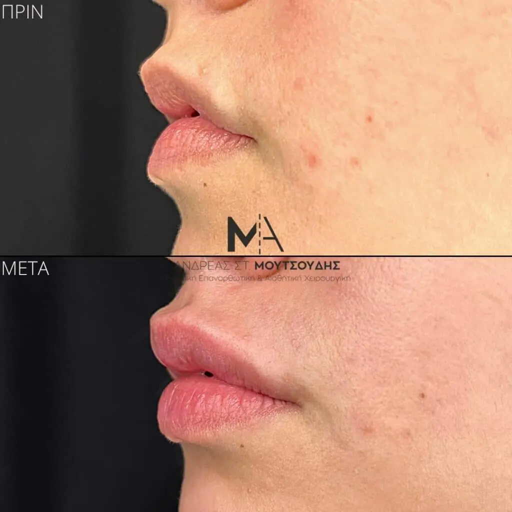 Υαλουρονικό Οξύ μέσα από αληθινές φωτογραφίες Πριν και Μετά