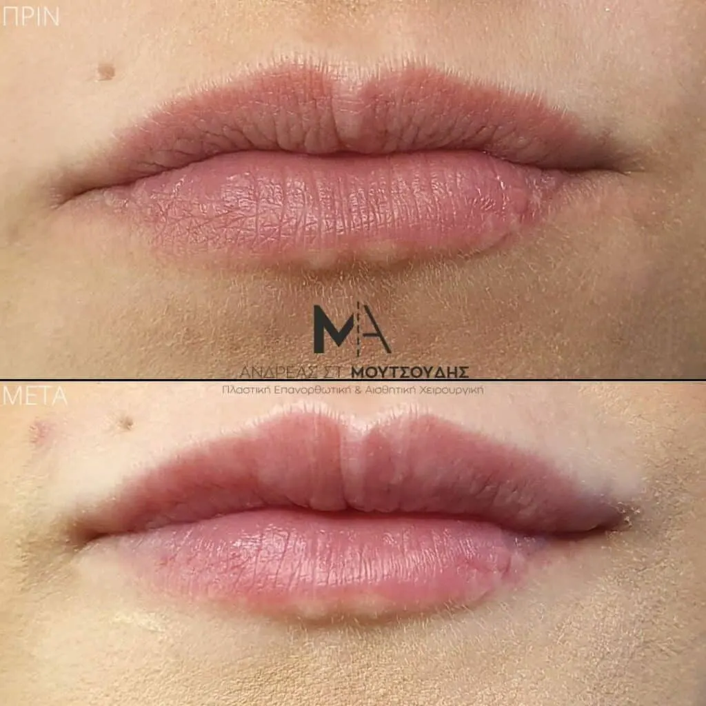 Υαλουρονικό Οξύ μέσα από αληθινές φωτογραφίες Πριν και Μετά