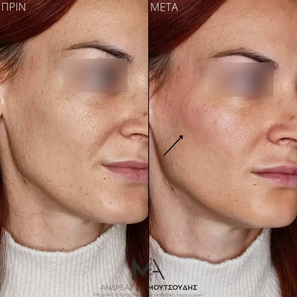 Υαλουρονικό Οξύ μέσα από αληθινές φωτογραφίες Πριν και Μετά