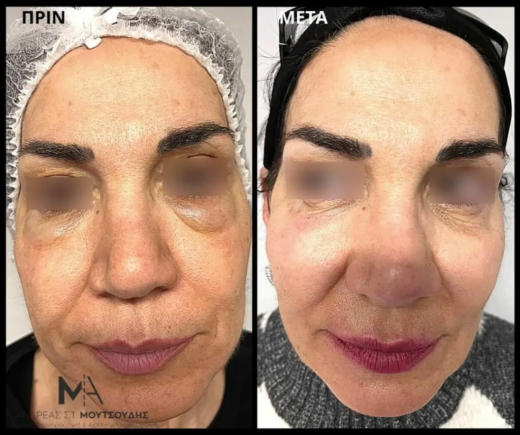 Υαλουρονικό Οξύ μέσα από αληθινές φωτογραφίες Πριν και Μετά