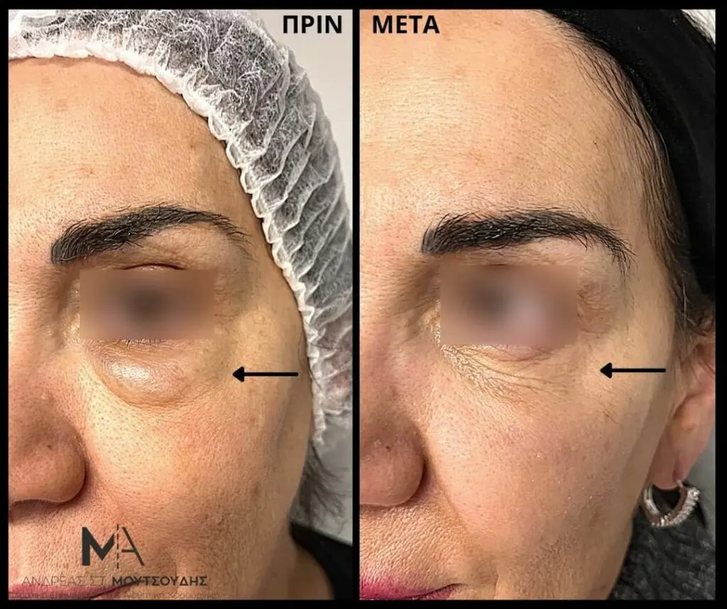 Υαλουρονικό Οξύ μέσα από αληθινές φωτογραφίες Πριν και Μετά