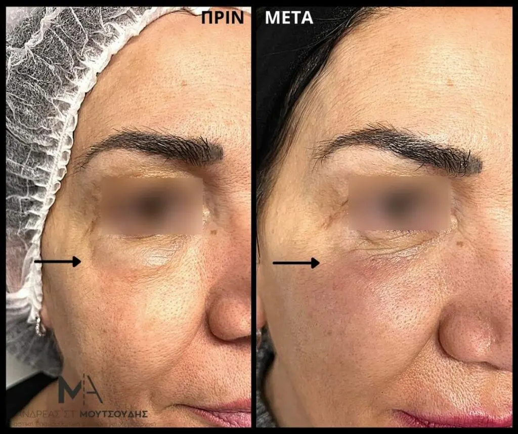 Υαλουρονικό Οξύ μέσα από αληθινές φωτογραφίες Πριν και Μετά