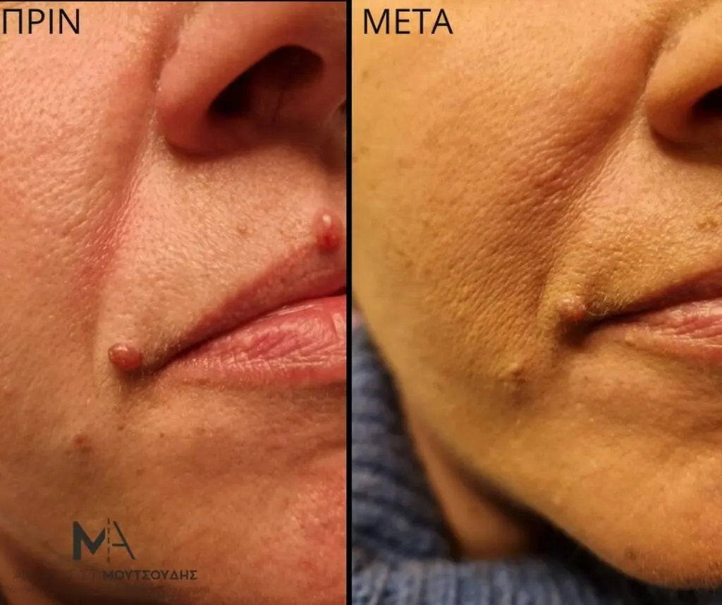Υαλουρονικό Οξύ μέσα από αληθινές φωτογραφίες Πριν και Μετά