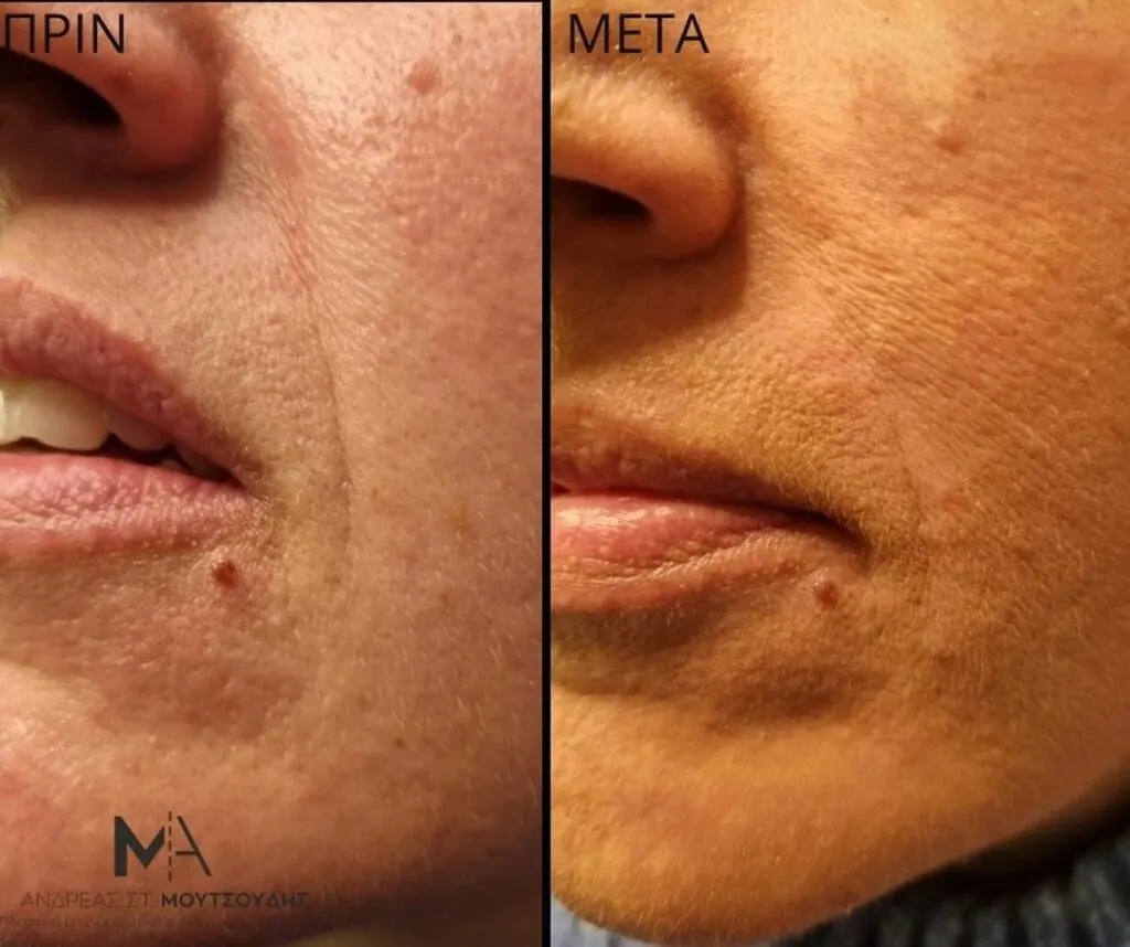 Υαλουρονικό Οξύ μέσα από αληθινές φωτογραφίες Πριν και Μετά