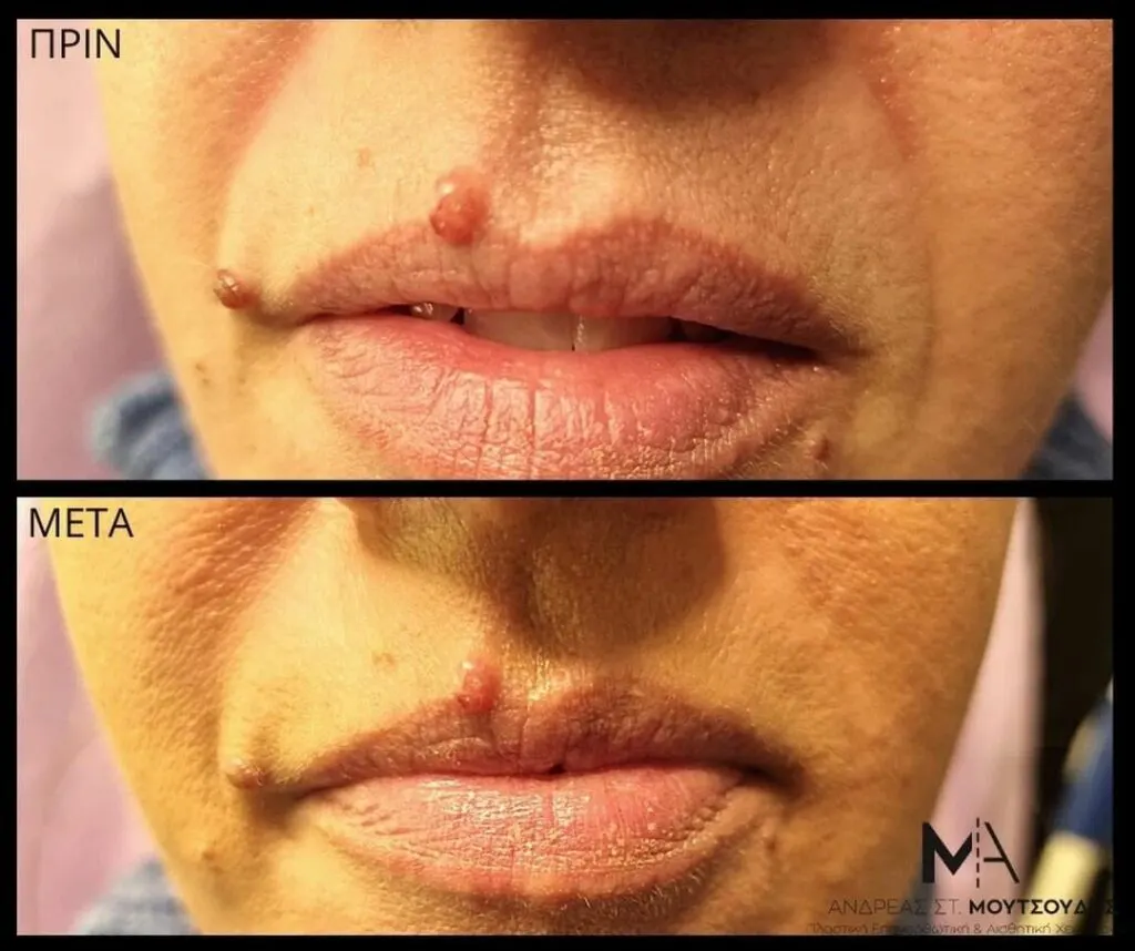 Υαλουρονικό Οξύ μέσα από αληθινές φωτογραφίες Πριν και Μετά