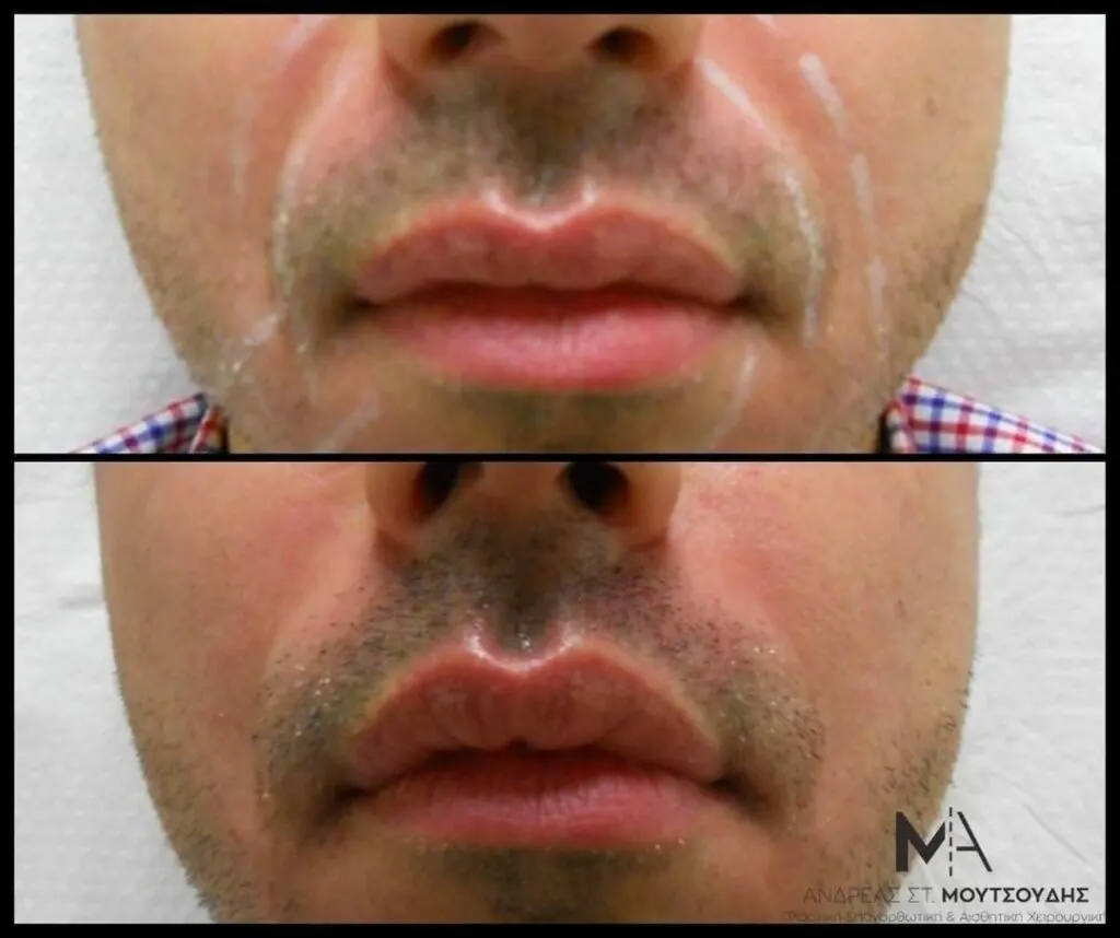 Υαλουρονικό Οξύ μέσα από αληθινές φωτογραφίες Πριν και Μετά