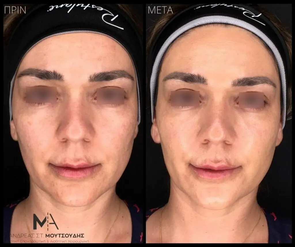 Υαλουρονικό Οξύ μέσα από αληθινές φωτογραφίες Πριν και Μετά