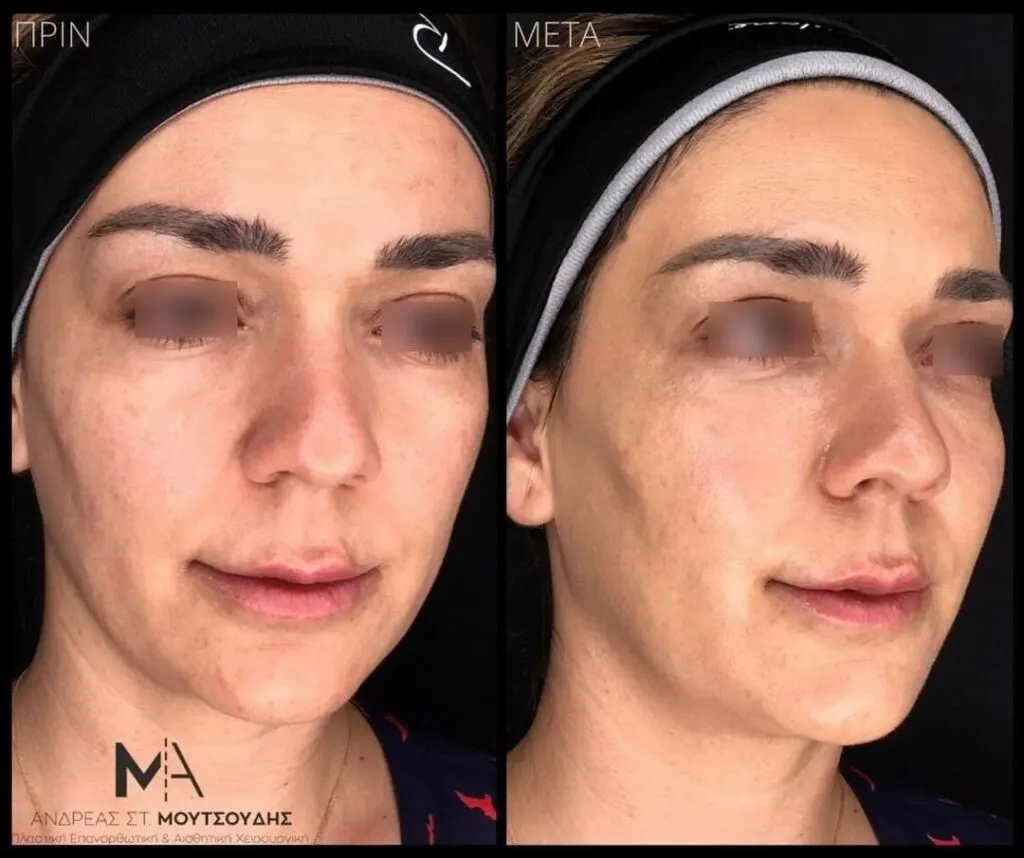 Υαλουρονικό Οξύ μέσα από αληθινές φωτογραφίες Πριν και Μετά