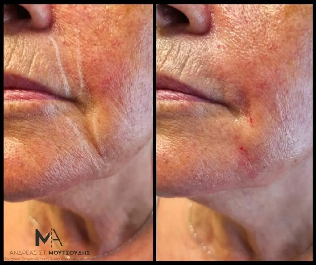 Υαλουρονικό Οξύ μέσα από αληθινές φωτογραφίες Πριν και Μετά