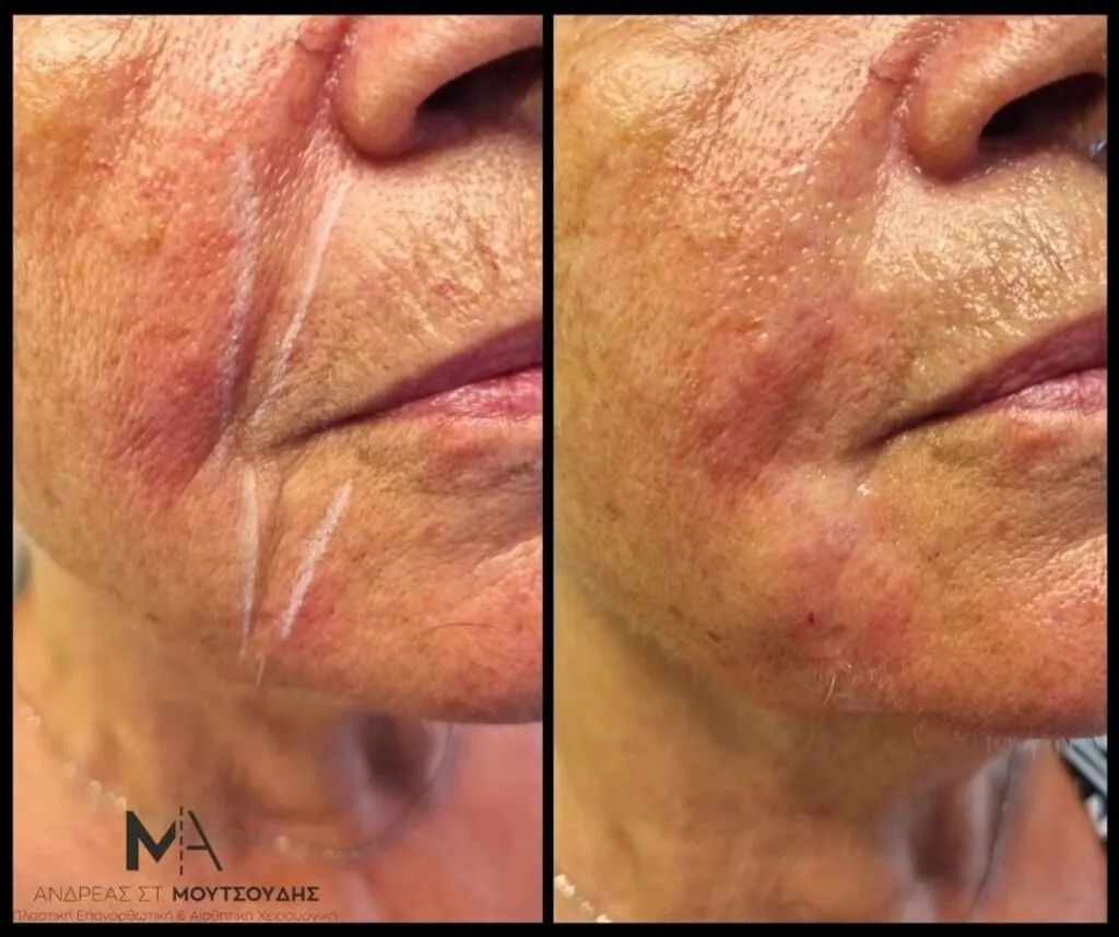 Υαλουρονικό Οξύ μέσα από αληθινές φωτογραφίες Πριν και Μετά