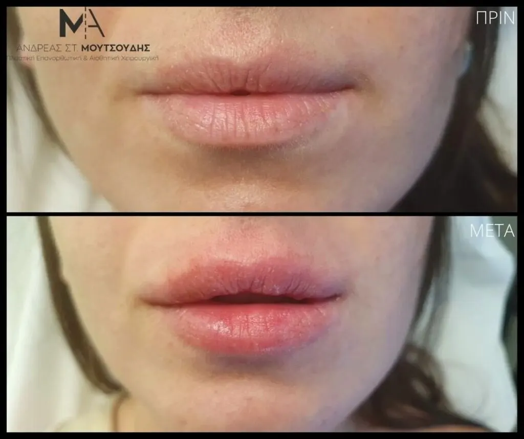 Υαλουρονικό Οξύ μέσα από αληθινές φωτογραφίες Πριν και Μετά