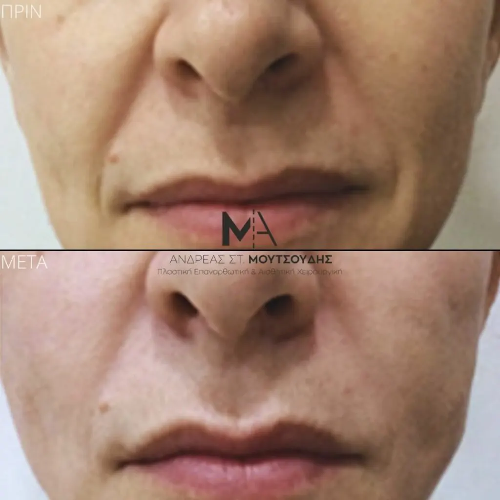 Υαλουρονικό Οξύ μέσα από αληθινές φωτογραφίες Πριν και Μετά