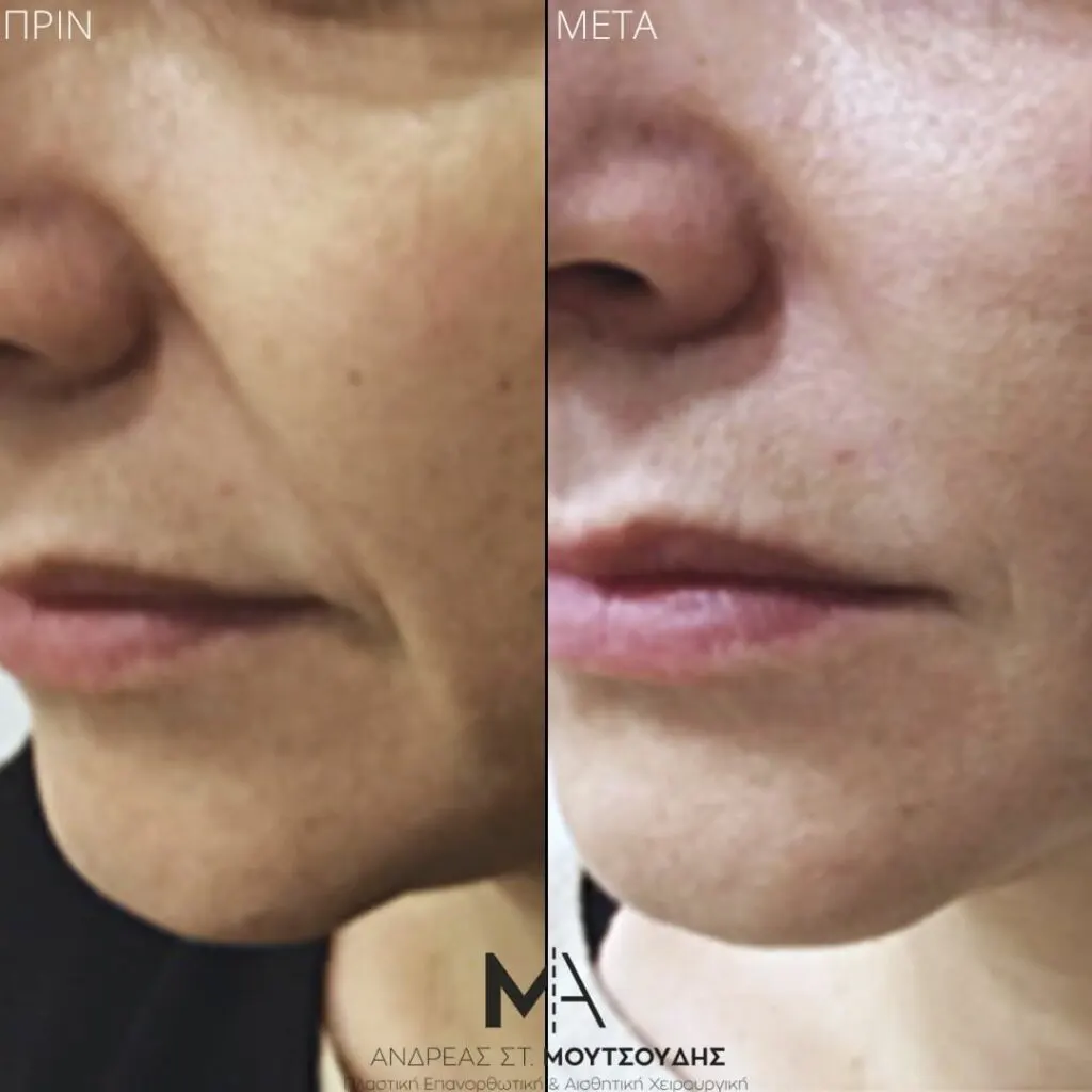 Υαλουρονικό Οξύ μέσα από αληθινές φωτογραφίες Πριν και Μετά