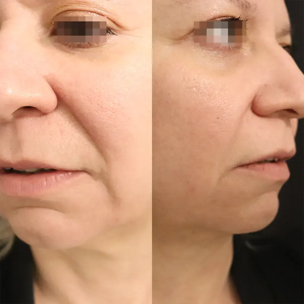 Υαλουρονικό Οξύ μέσα από αληθινές φωτογραφίες Πριν και Μετά