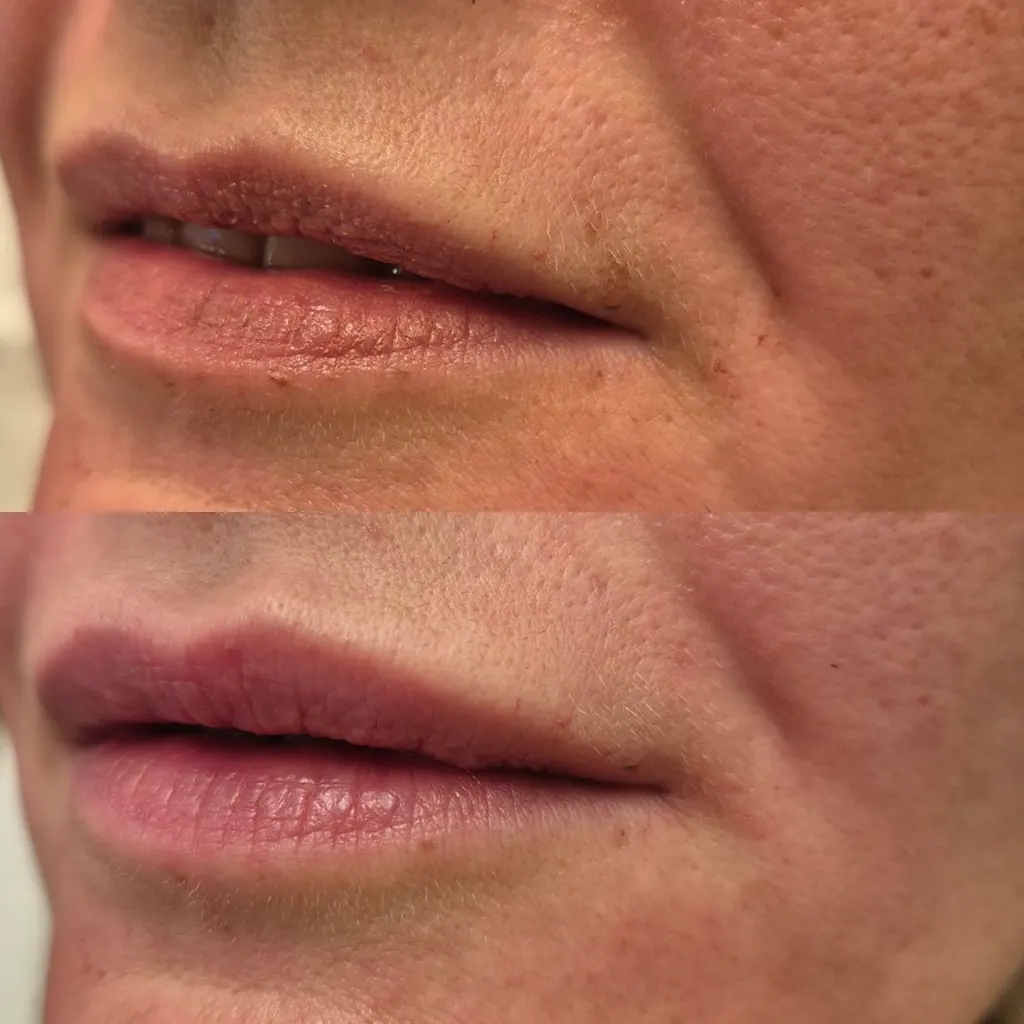 Υαλουρονικό Οξύ μέσα από αληθινές φωτογραφίες Πριν και Μετά