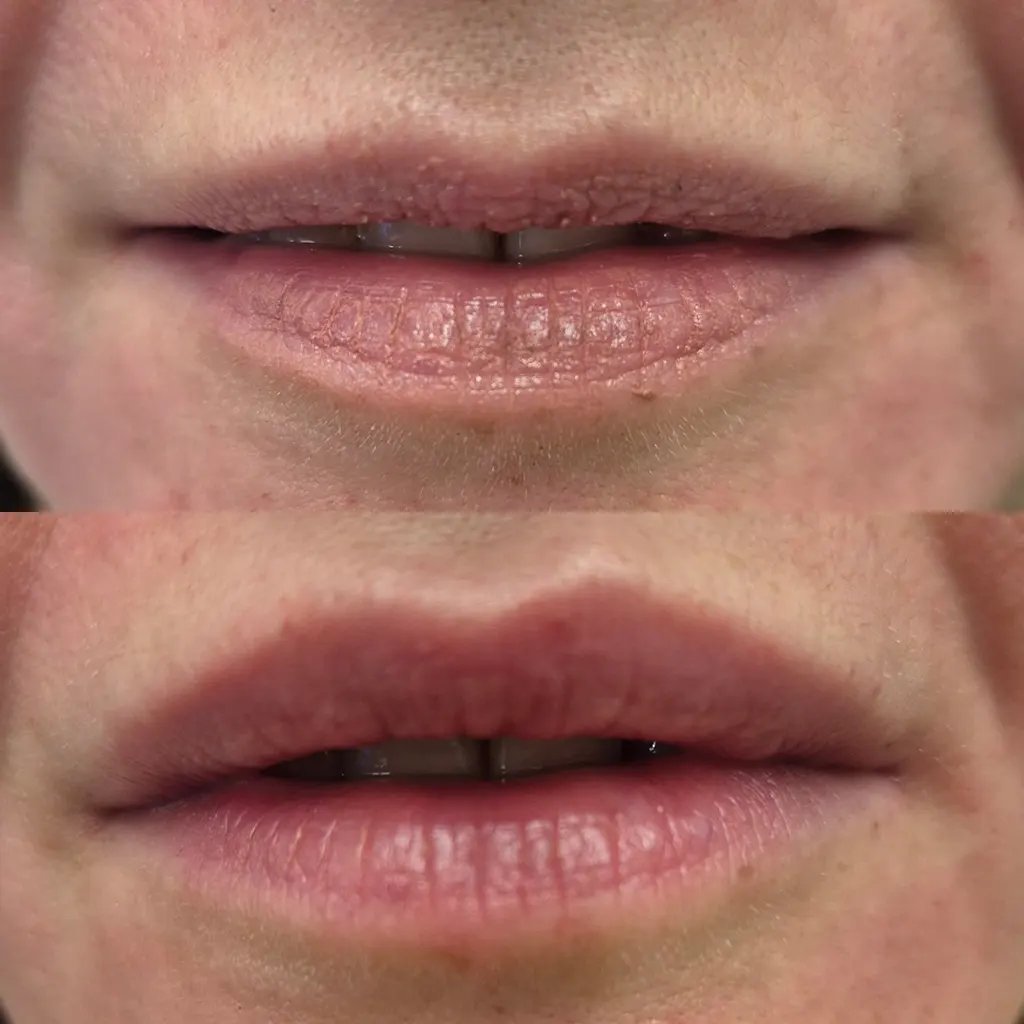 Υαλουρονικό Οξύ μέσα από αληθινές φωτογραφίες Πριν και Μετά