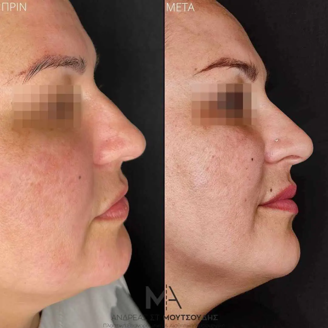 Υαλουρονικό Οξύ μέσα από αληθινές φωτογραφίες Πριν και Μετά