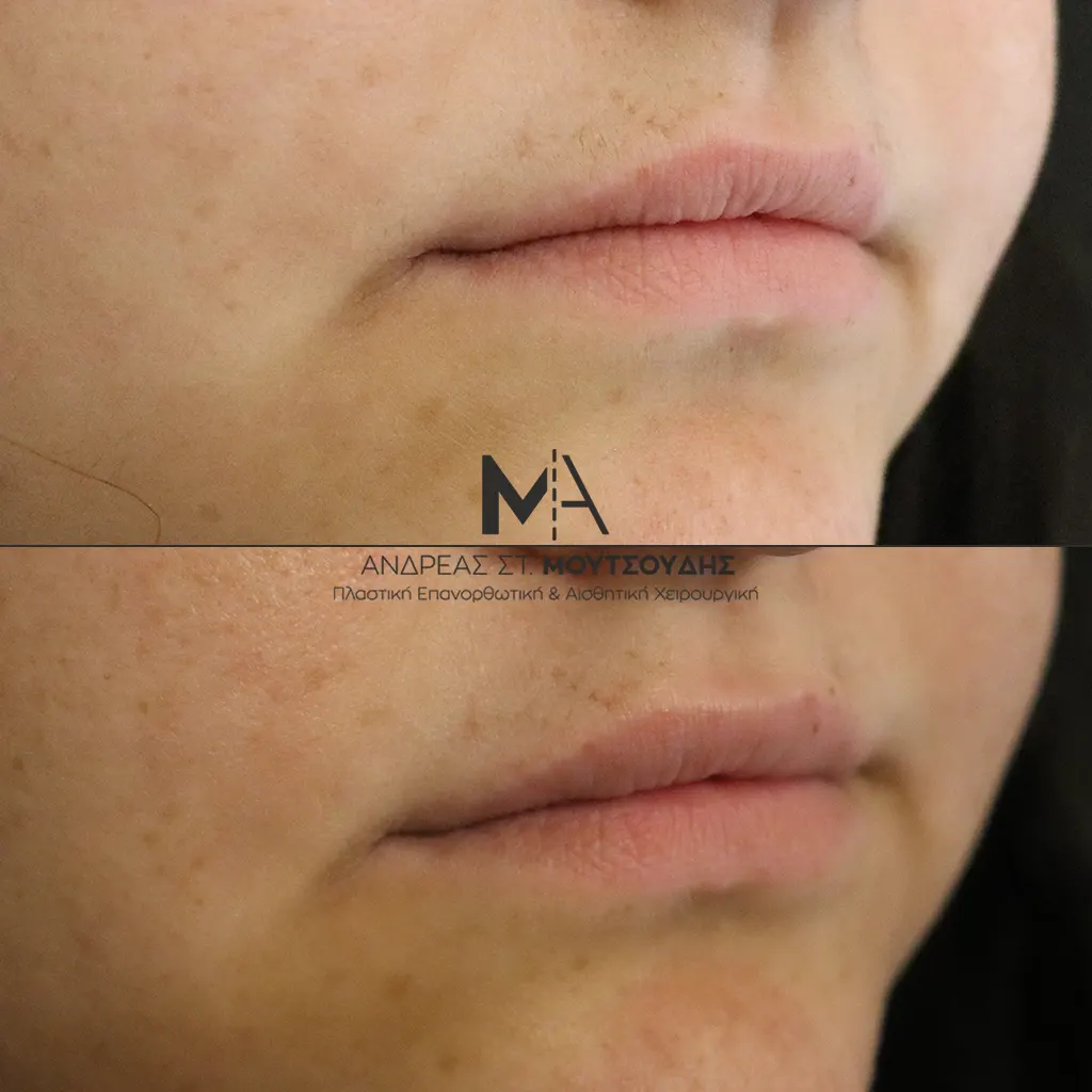 Υαλουρονικό Οξύ μέσα από αληθινές φωτογραφίες Πριν και Μετά