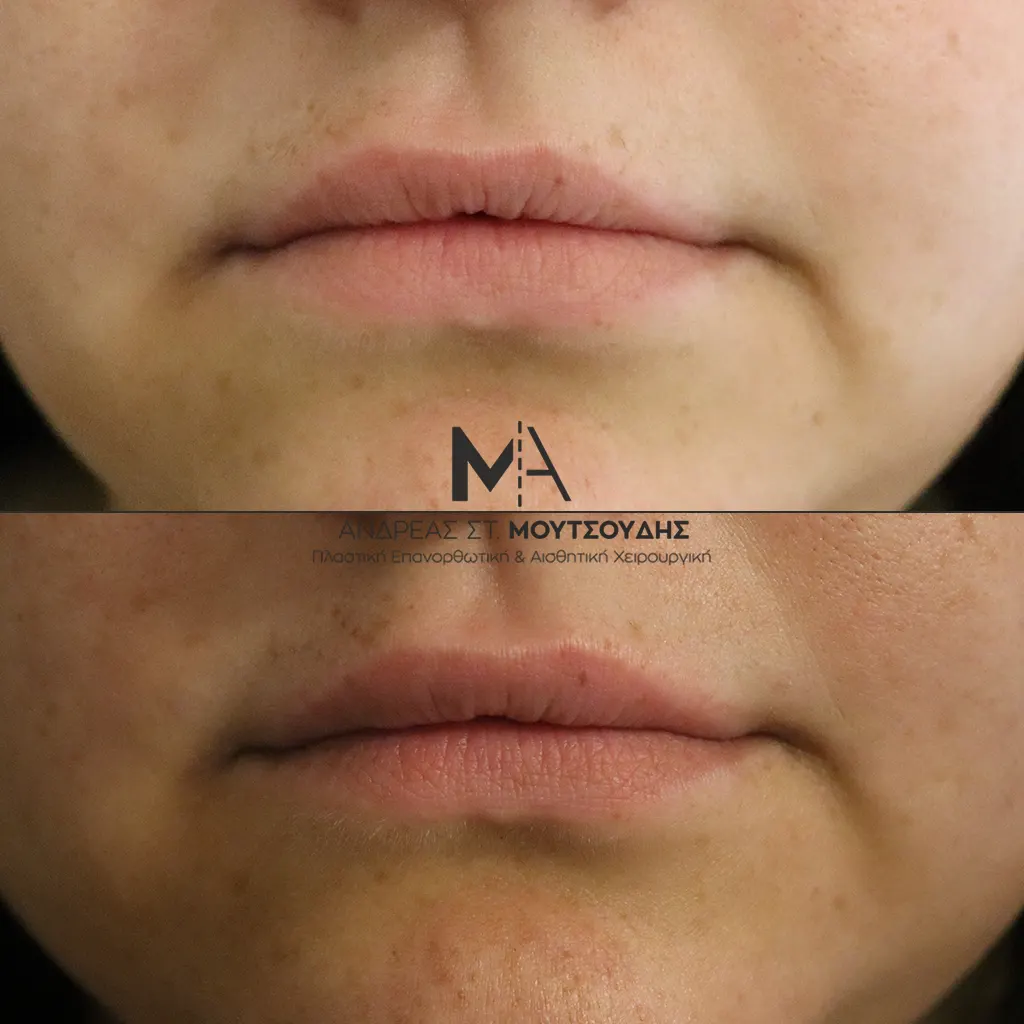 Υαλουρονικό Οξύ μέσα από αληθινές φωτογραφίες Πριν και Μετά