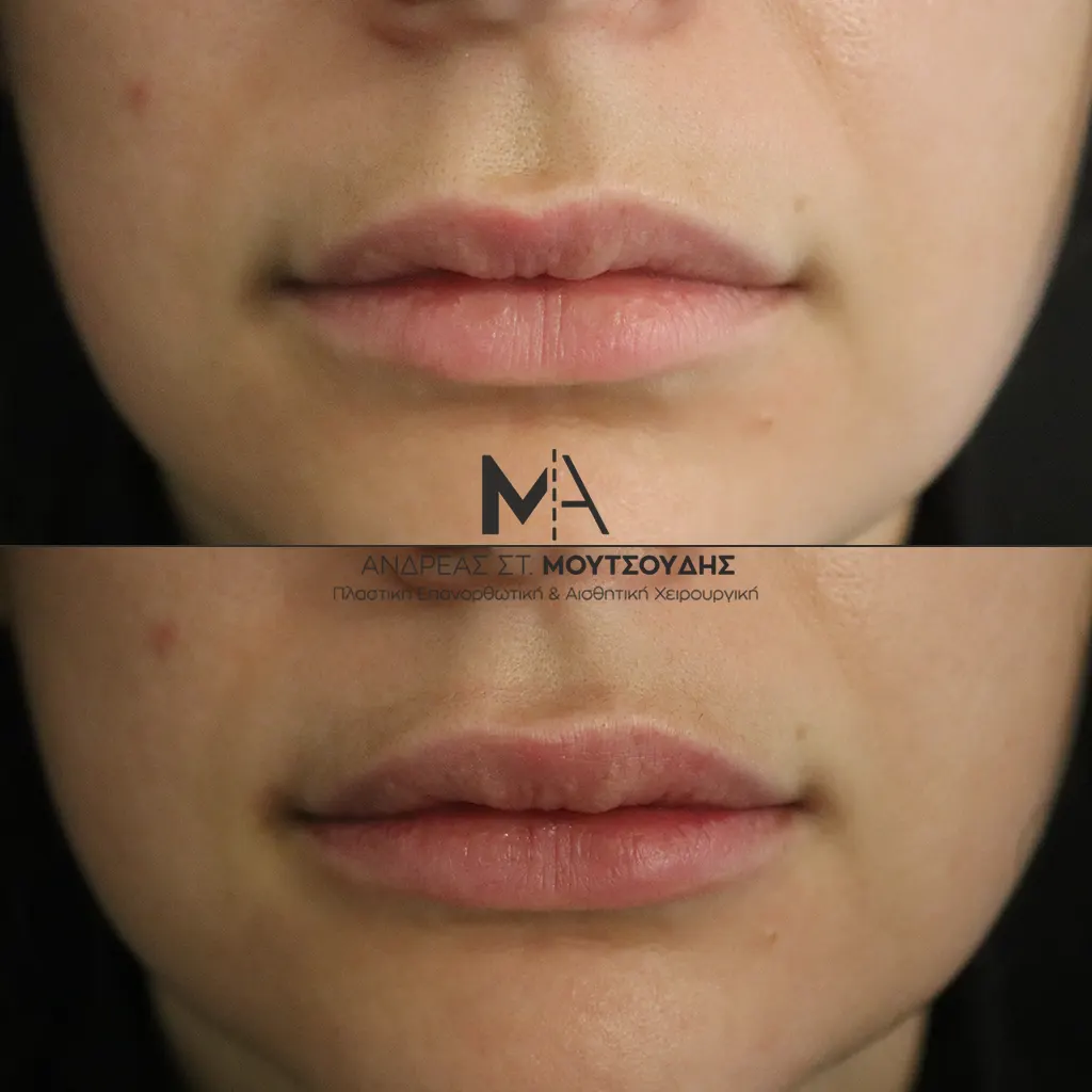 Υαλουρονικό Οξύ μέσα από αληθινές φωτογραφίες Πριν και Μετά