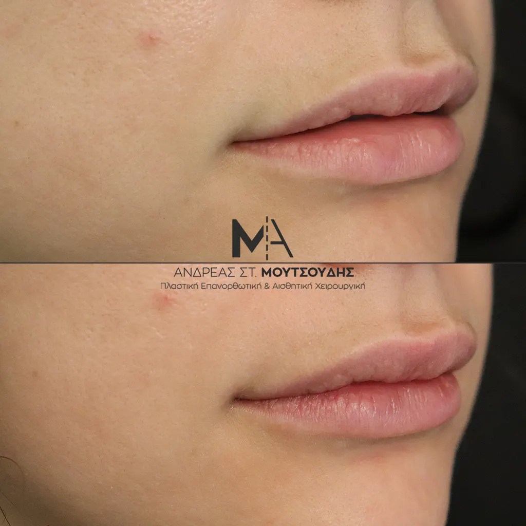 Υαλουρονικό Οξύ μέσα από αληθινές φωτογραφίες Πριν και Μετά